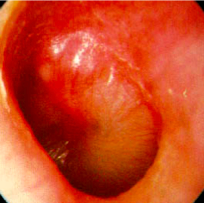 infected ear